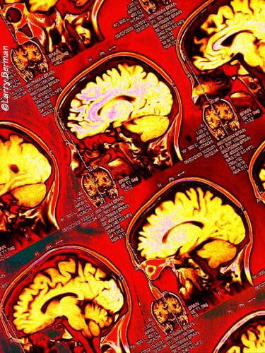 MRI Brain XRay